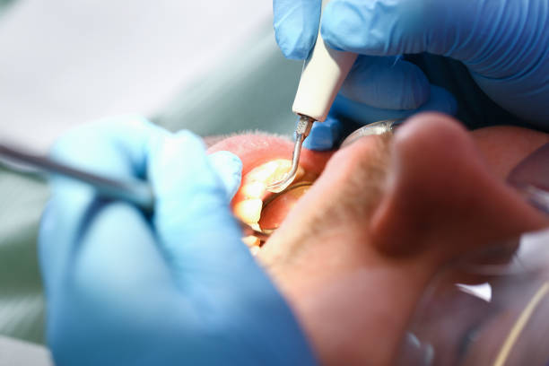 Best Emergency Tooth Extraction in Carlinvle, IL