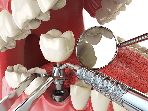Best Emergency Tooth Extraction in Carlinvle, IL
